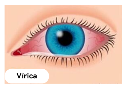 foto de dibujo de un ojo con conjuntivitis vírica