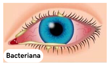 foto de dibujo de un ojo con conjuntivitis bacteriana